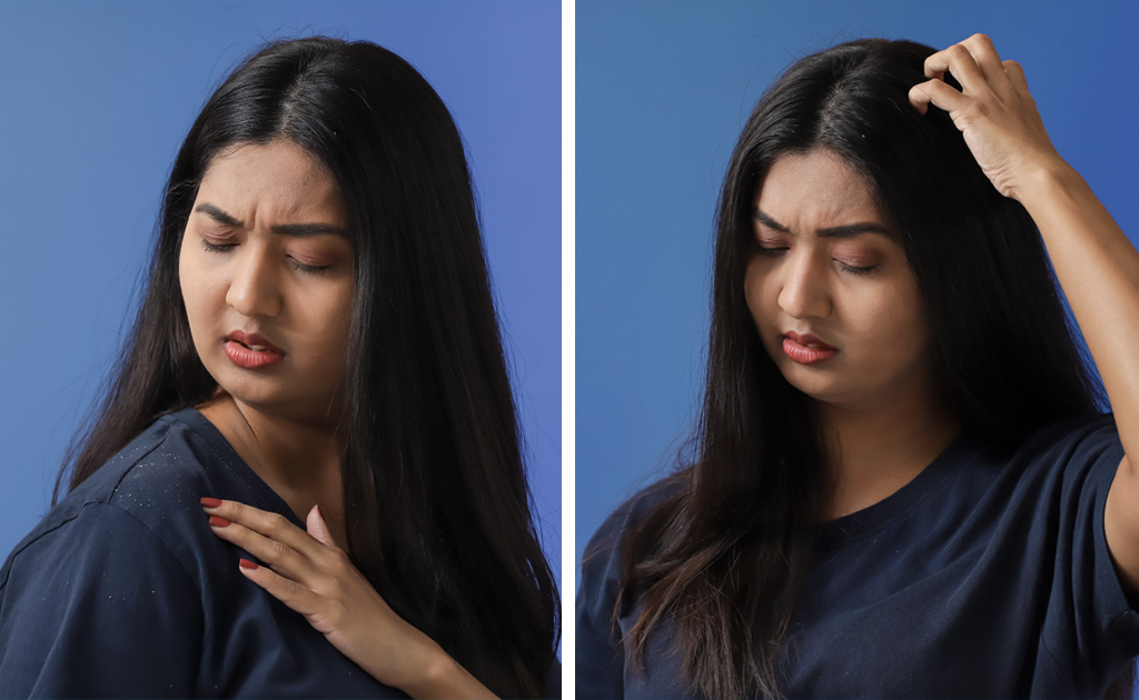 ড্যানড্রাফ নাকি ড্রাই স্ক্যাল্প – আপনি কোন সমস্যায় ভুগছেন?