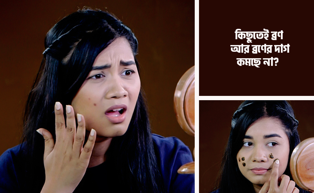 কিছুতেই ব্রণ আর ব্রণের দাগ কমছে না?