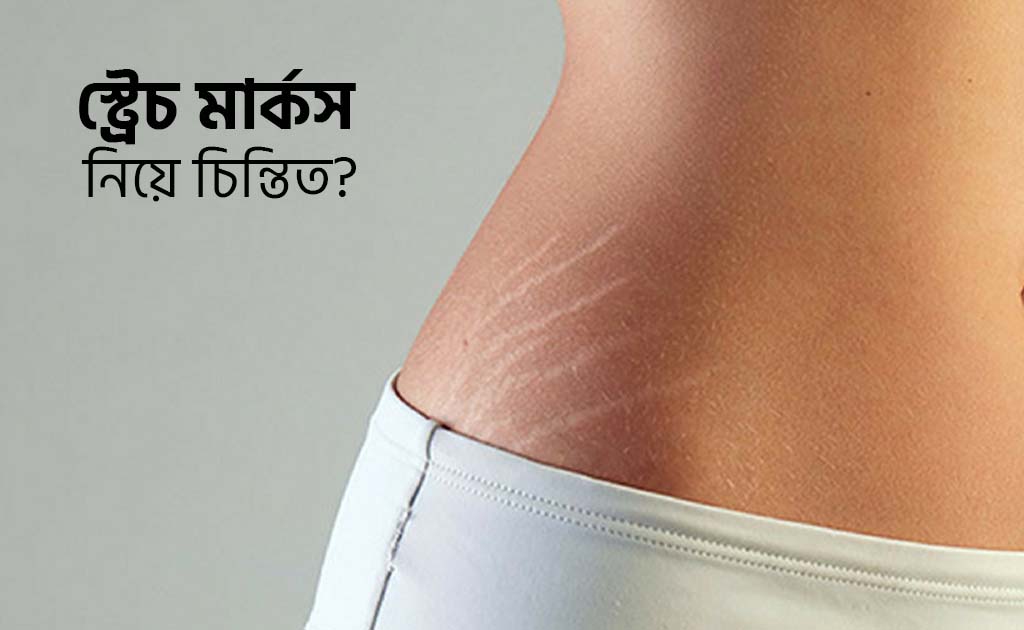 স্ট্রেচ মার্কস নিয়ে চিন্তিত?