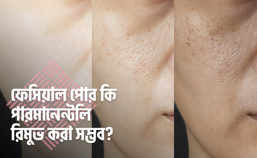 ফেসিয়াল পোর কি পারমানেন্টলি রিমুভ করা সম্ভব?