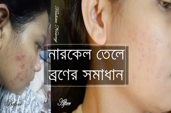 শুধুমাত্র নারকেল তেলেই যেভাবে ব্রণ থেকে মুক্তি পেলাম