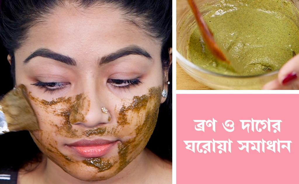 ব্রণ ও দাগের ঘরোয়া সমাধান