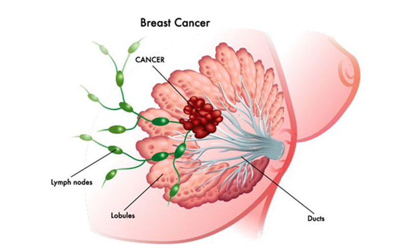 স্তনের ক্যান্সার - shajgoj.com