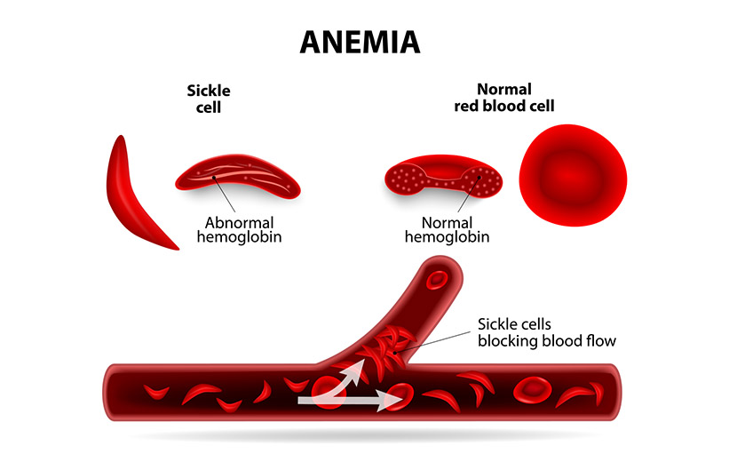 সিকেল সেল ও নরমাল ব্লাড সেল - shajgoj.com