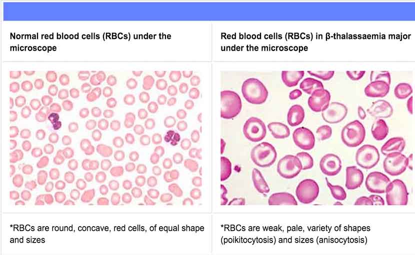 মাইনর ও মেজর থ্যালাসেমিয়া - shajgoj.com