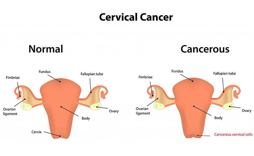 জরায়ু মুখের ক্যান্সার বা cervical cancer - shajgoj.com