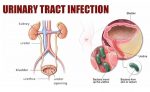ইউরিন ইনফেকশন - shajgoj