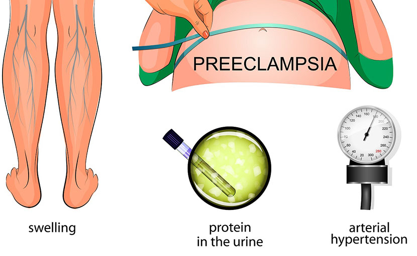 গর্ভকালীন প্রি-এক্লাম্পসিয়া - shajgoj.com