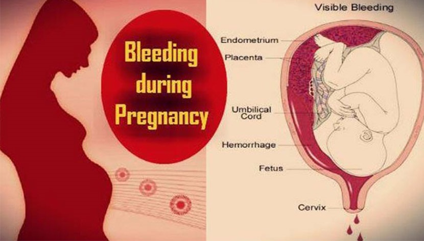 গর্ভধারণের প্রথম দিকে গর্ভপাত হওয়ার উপসর্গ ব্লিডিং - shajgoj.com