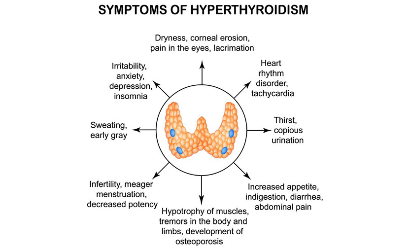হাইপারথাইরয়েডিজম এর উপসর্গগুলো - shajgoj.com