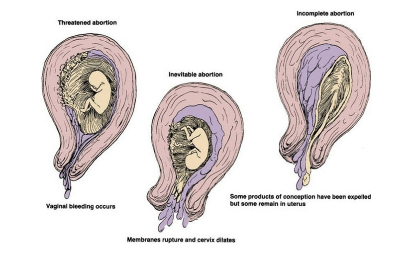 গর্ভধারণের প্রথম দিকে গর্ভপাত এর নমুনা - shajgoj.com