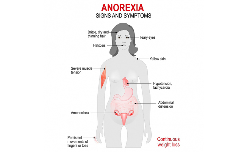 ক্ষুধাহীনতা বা অ্যানোরেক্সিয়া নার্ভোসার লক্ষণ - shajgoj.com