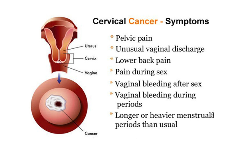 Cancer de utero tiene cura