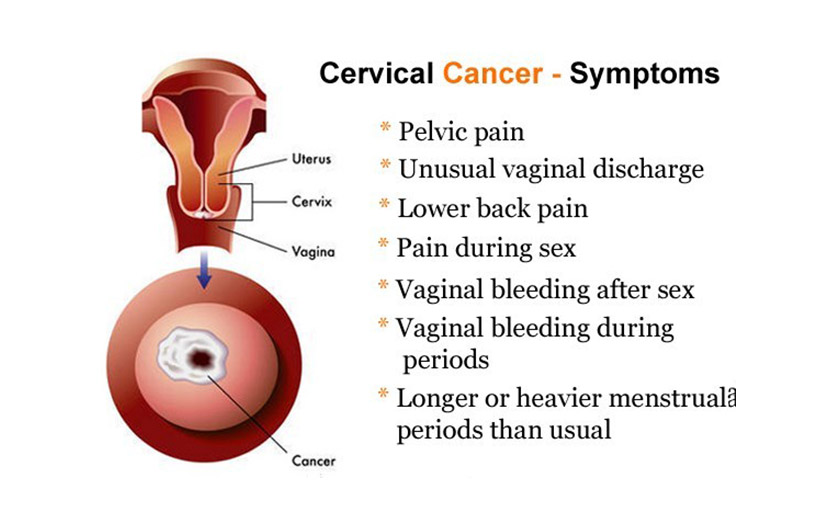 সার্ভিকেল ক্যান্সারের লক্ষণসমূহ - shajgoj.com