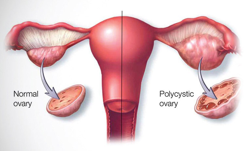 বন্ধ্যাত্বের কারণ পলিসিস্টিক ওভারিয়ান সিনড্রোম - shajgoj