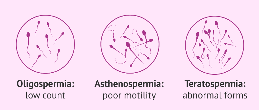 বন্ধ্যাত্বে আইইউআই হয় অলিগোস্পারমিয়া, এস্থিনোস্পারমিয়া ও টেরাটোস্পারমিয়া সমস্যায় - shajgoj