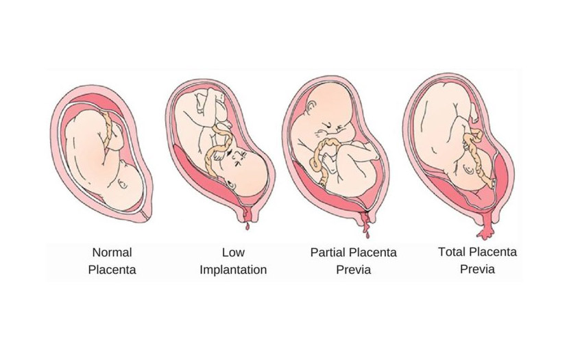 সিজারের পর নরমাল ডেলিভারি সম্ভব নয় প্লাসেন্টা প্রিভিয়াতে - shajgoj.com
