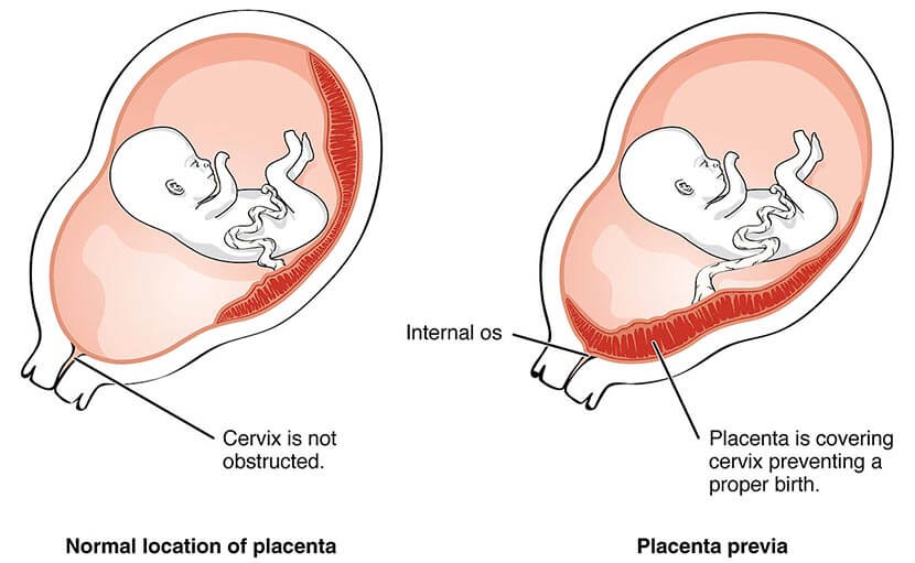 গর্ভাবস্থায় প্লাসেন্টা প্রিভিয়ার লক্ষণ - shajgoj.com