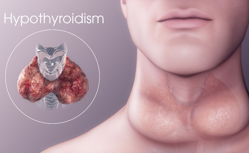 hypothyroidism জন্মগত ত্রুটির কারণে হতে পারে - shajgoj