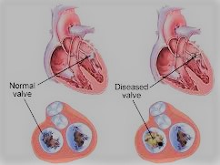  কার্ডিয়াক (ভালব) সমস্যা জন্মগত ত্রুটির কারণে হতে পারে - shajgoj