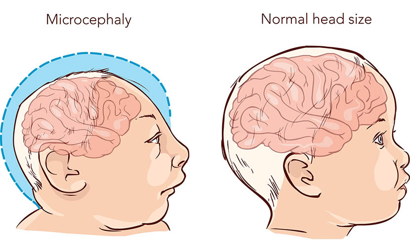 Zika virus এ শিশুর জন্মগত ত্রুটি - shajgoj.com