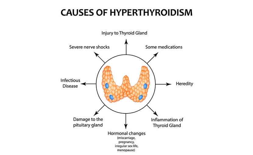 হাইপারথাইরয়েডিজম এর কারণ সমূহ যা হরমোনাল ইমব্যালেন্স ঘটায় - shajgoj.com