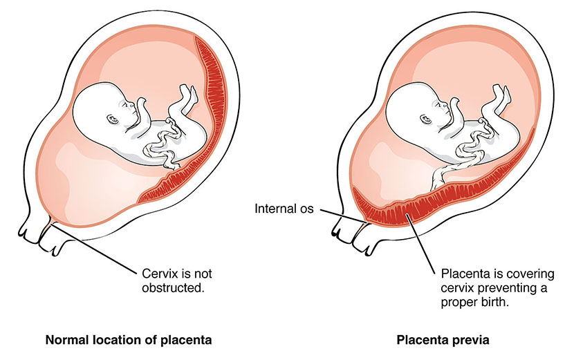গর্ভাবস্থায় মায়ের ৮টি বিপদ চিহ্নের ১টি প্লাসেন্টা প্রিভিয়া - shajgoj.com
