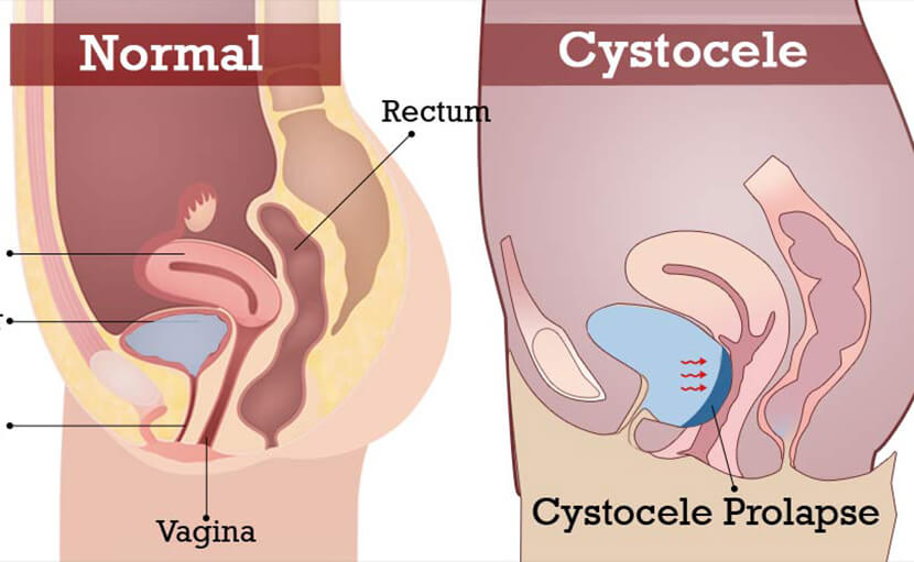 জরায়ু নিচে নেমে যাওয়ায় প্রলাপসকে জটিল করে তোলে cystocele - shajgoj.com
