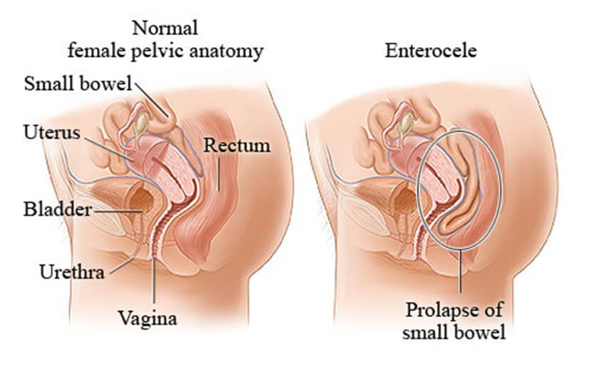 জরায়ুকে জটিল করে তোলে Enterocele - shajgoj.com