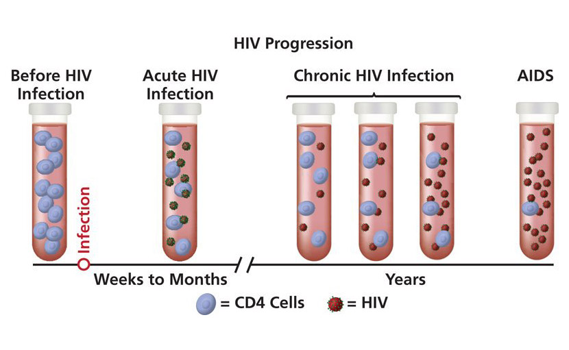 এইডস ( HIV ) এর progression এর ছবি - shajgoj