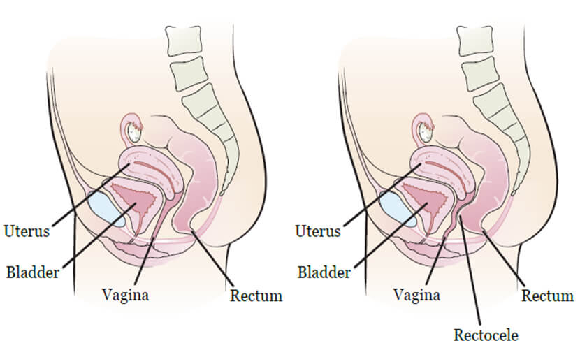 জরায়ুকে জটিল করে তোলে Rectocele - shajgoj.com
