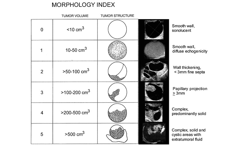 ওভারিয়ান সিস্ট নাকি টিউমার এ নিয়ে Morphology Index - shajgoj