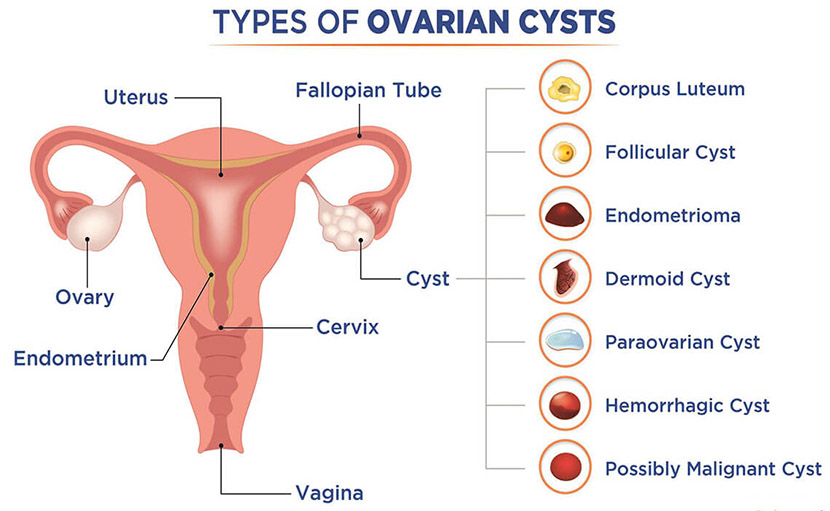  ওভারিয়ান সিস্ট এর টাইপ - shajgoj