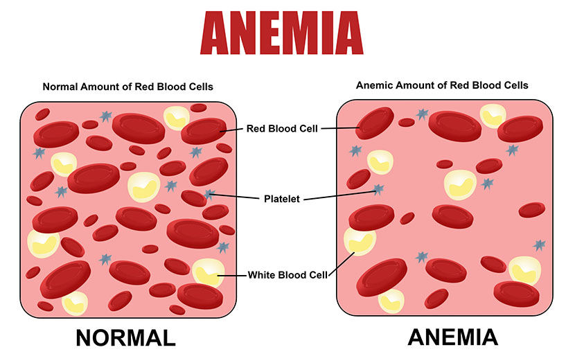 রক্তশূন্যতা বা Anemia তে ব্লাড সেল ও নরমাল ব্লাড সেল - shajgoj