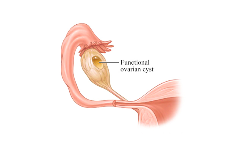 ফাংশনাল ওভারিয়ান সিস্টের লক্ষণ - shajgoj.com