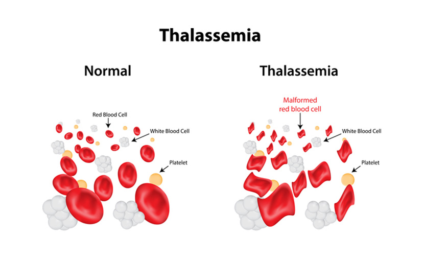 রক্তশূন্যতা বা Anemia থ্যালাসেমিয়ার কারণে হয়- shajgoj