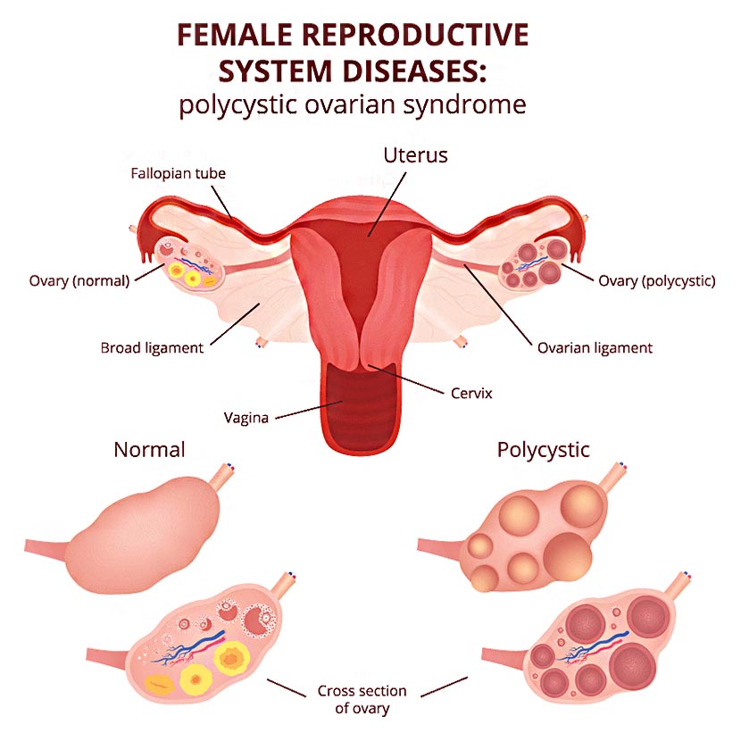 ইনফার্টিলিটি হওয়ার কারণ পলিসিসটিক ওভারিয়ান সিনড্রোম (PCOS) - shajgoj.com