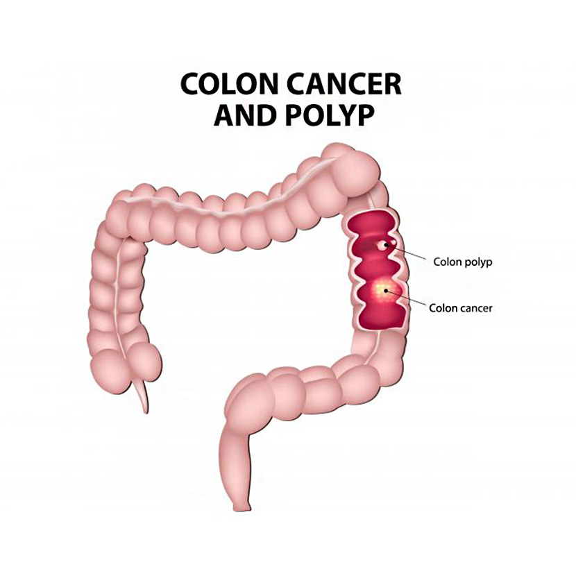 কোলন ক্যান্সার ও পলিপ - shajgoj.com