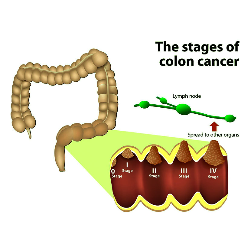 কোলন ক্যান্সার এর স্টেইজ সমূহ - shajgoj.com