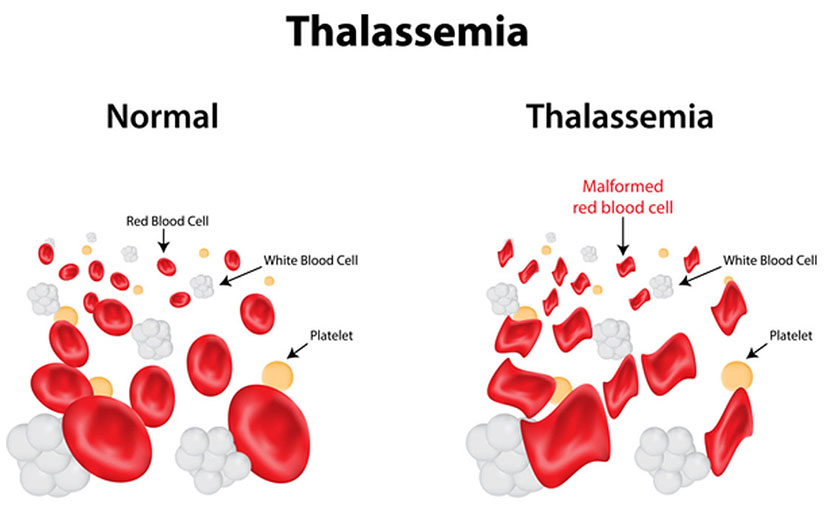 থ্যালাসেমিয়া থাকলে গর্ভধারণের পূর্বে ডাক্তারি পরামর্শ নিন - shajgoj.com