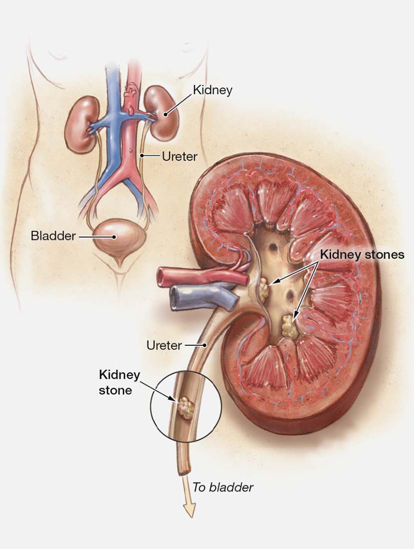 কিডনির পাথর - shajgoj.com