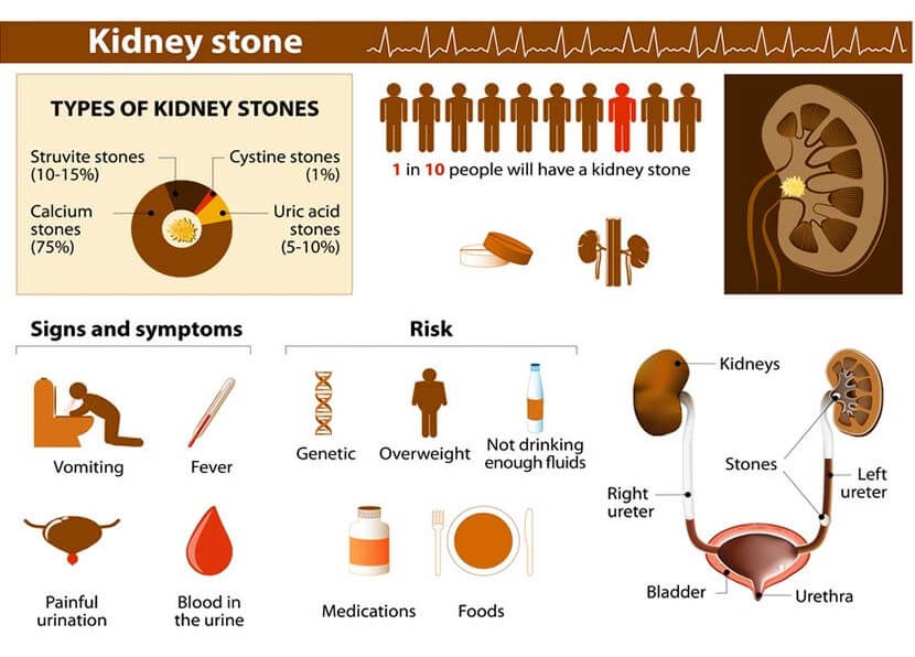 কিডনিতে পাথর হওয়ার লক্ষণসমূহ - shajgoj.com