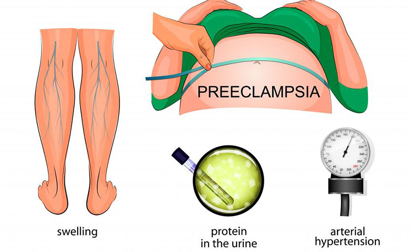 গর্ভাবস্থায় প্রি-এক্লাম্পসিয়া - shajgoj.com
