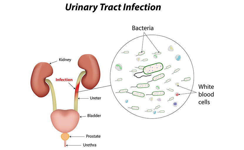 মূত্রনালীর সংক্রমণ বা ইউটিআই - shajgoj.com