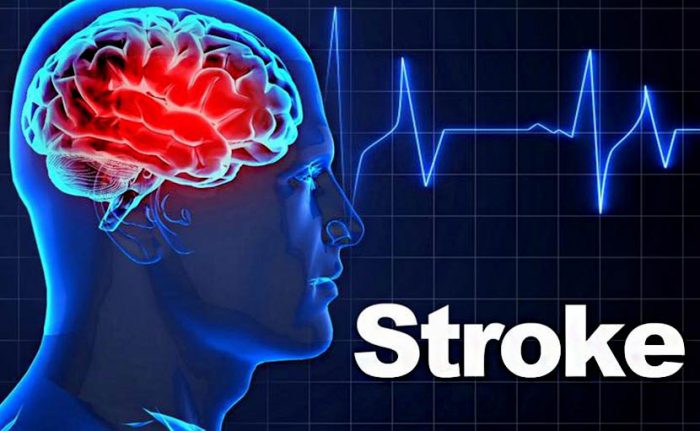 a stroke os betegek fogynak e hogyan fogyjak le a hasamról