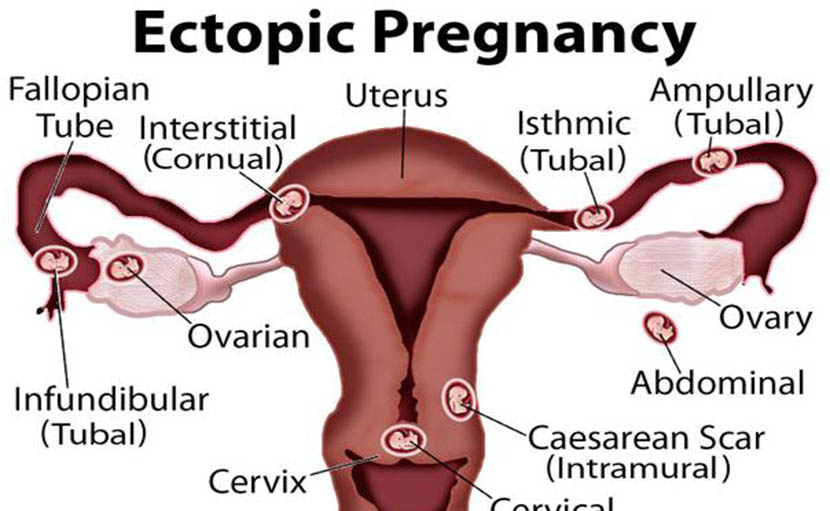 গর্ভাবস্থায় জরায়ুতে ব্যথার কারণ একটোপিক প্রেগনেন্সি - shajgoj.com