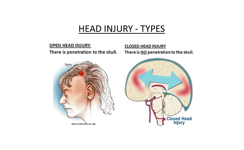 হেড ইনজুরির ধরন - shajgoj.com