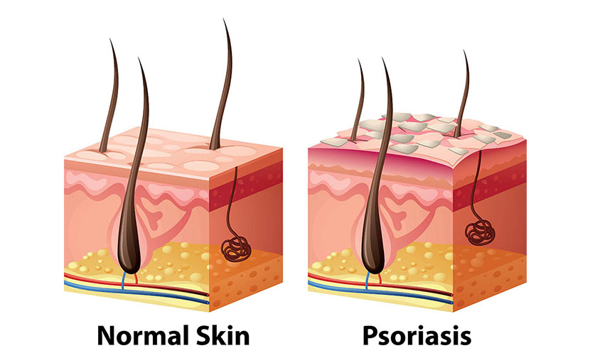 স্বাভাবিক স্কিন ও সোরিয়াসিস স্কিন - shajgoj.com
