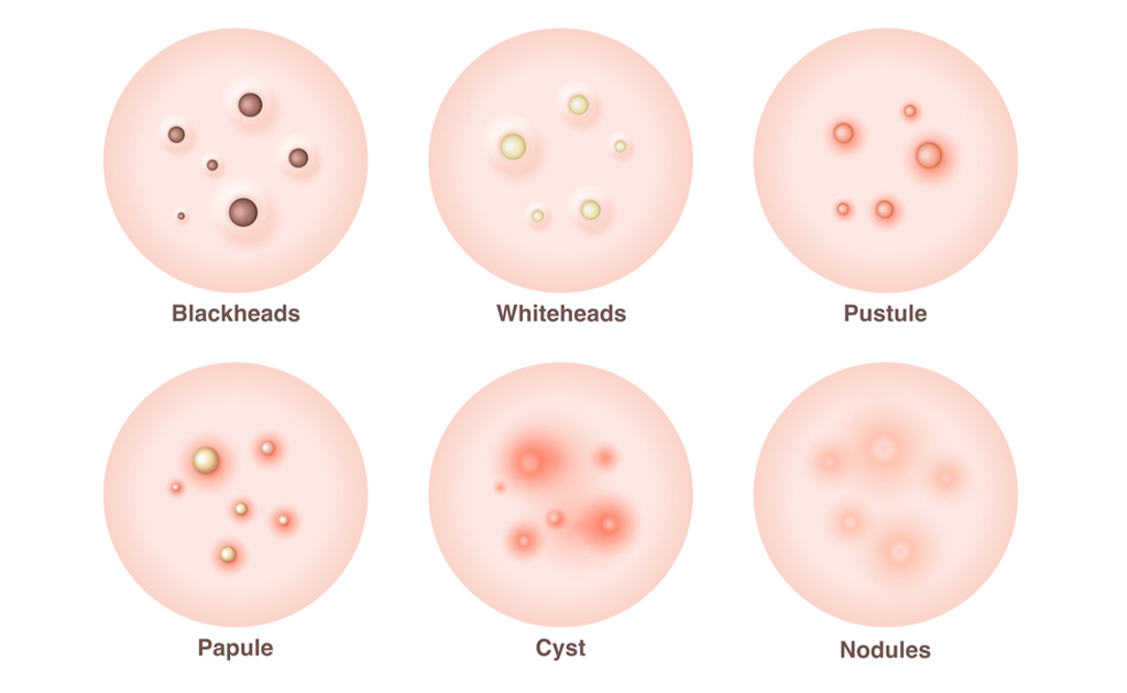 পিম্পলের প্রকারভেদ 