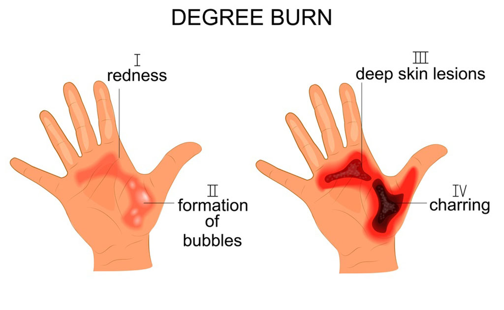 Degree Burn